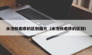 水泡和疱疹的区别图片（水泡和疱疹的区别）